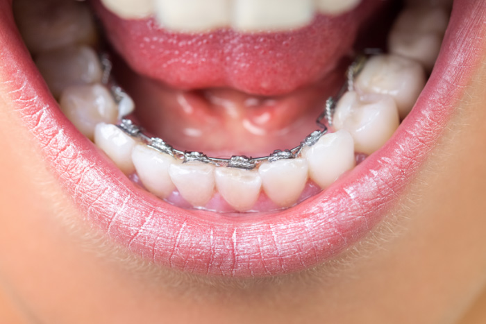 舌側牙箍的部件是固定在牙齒內側，相比傳統箍牙方法更加隱藏。