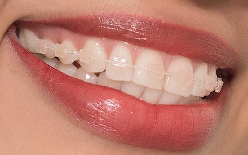 牙箍是用陶瓷製成，所以能造出（幾乎）透明的效果。