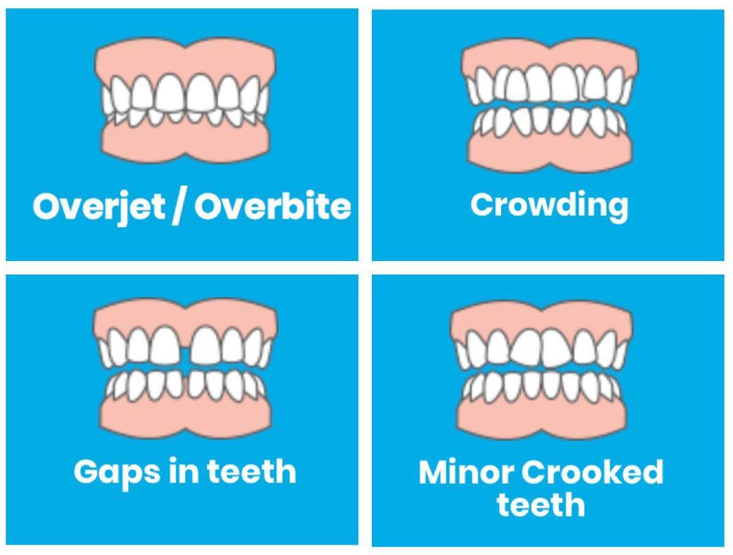 Various teeth issues: Overjet/Overbite, Crowding, Gaps in teeth, Minor crooked teeth