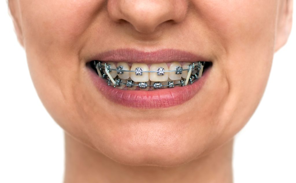 Person smiling widely wearing traditional metal braces