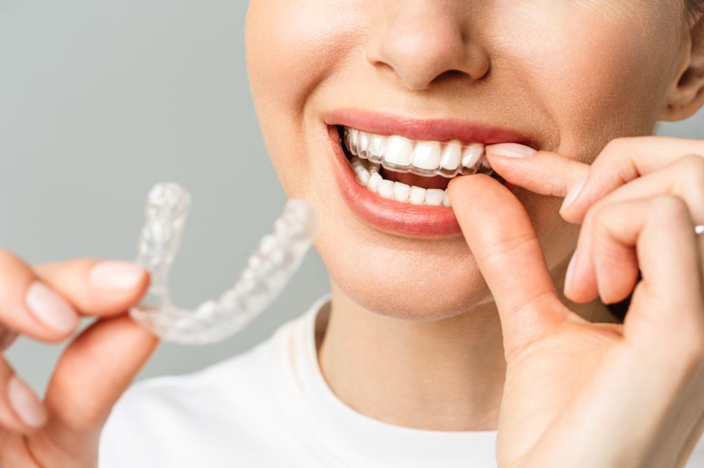 Person smiling putting on clear aligners