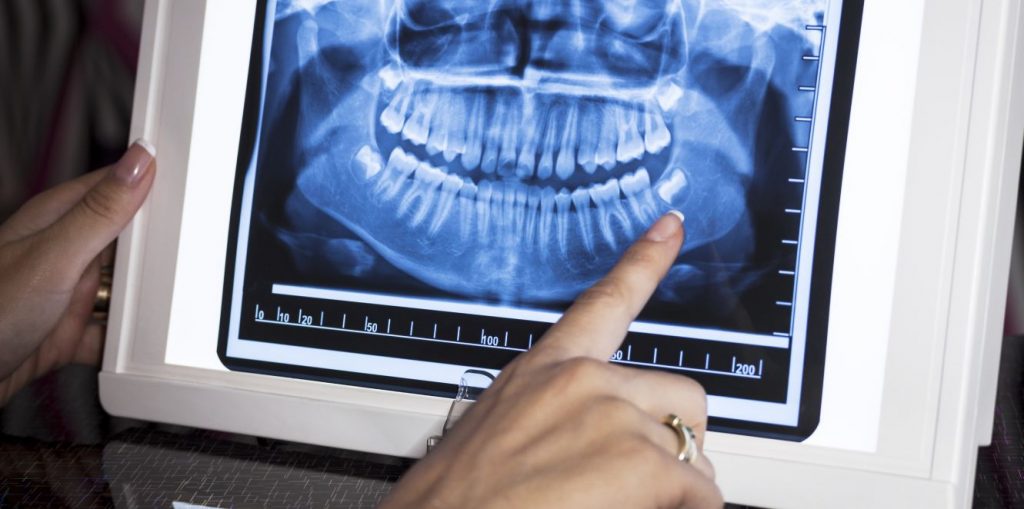 Zenyum 會開始箍牙療程前 X 光檢查及簡單口腔評估。