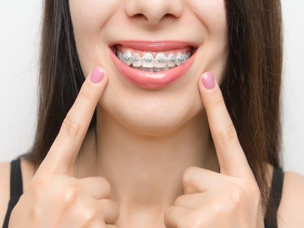 Niềng răng mắc cài kim loại là phương pháp lâu đời nhất hiện nay.