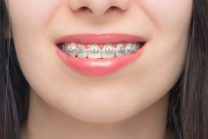 Lady smiling with metal braces