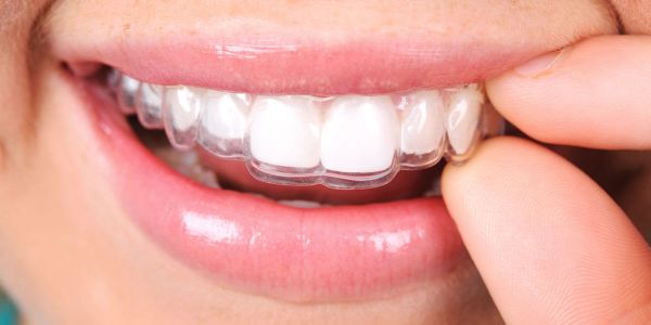 Niềng răng trong suốt là phương pháp chỉnh nha được đánh giá tiên tiến nhất hiện nay.