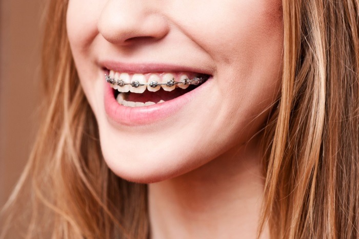 Niềng răng mắc cài kim loại truyền thống là phương pháp cơ bản nhất hiện nay.