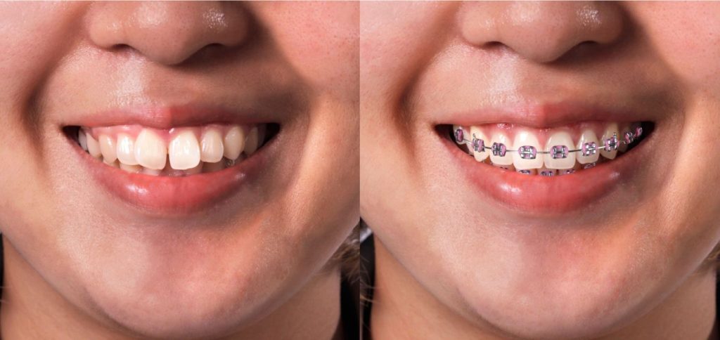Comparison of before and after traditional braces