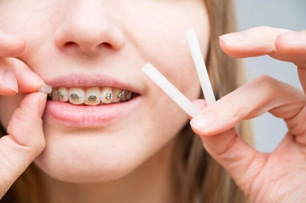 Niềng răng có đâu không - dùng sáp nha khoa để giảm đau