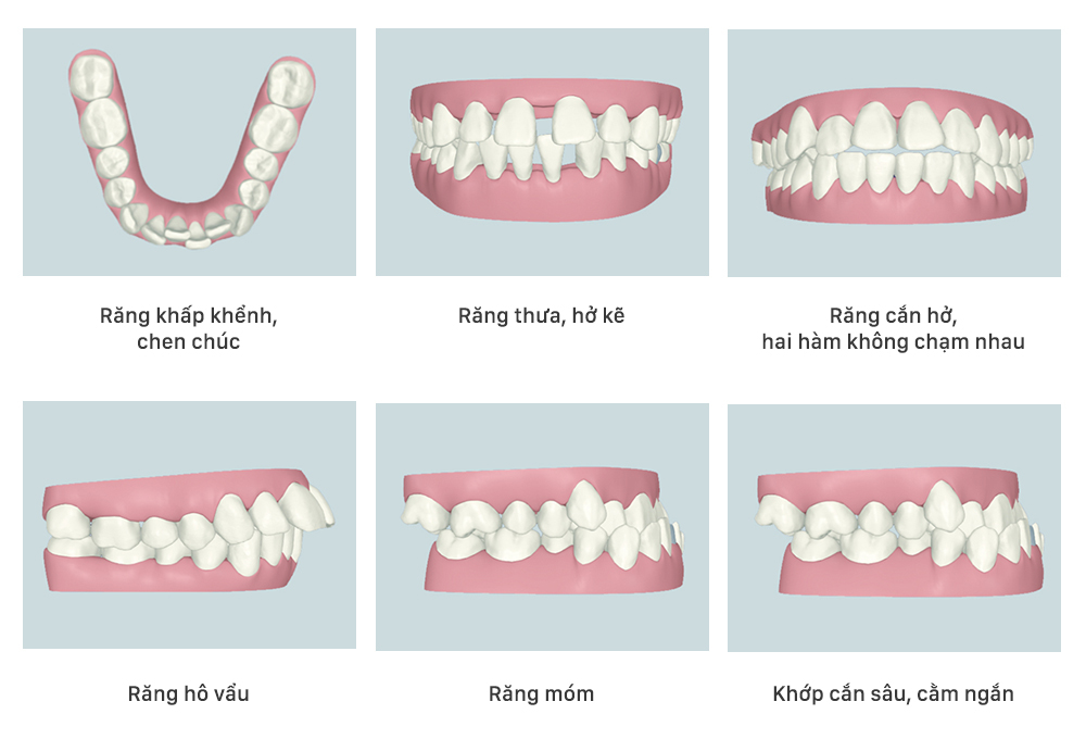 nhổ răng sẽ được chỉ định tùy vào ca niềng khác nhau