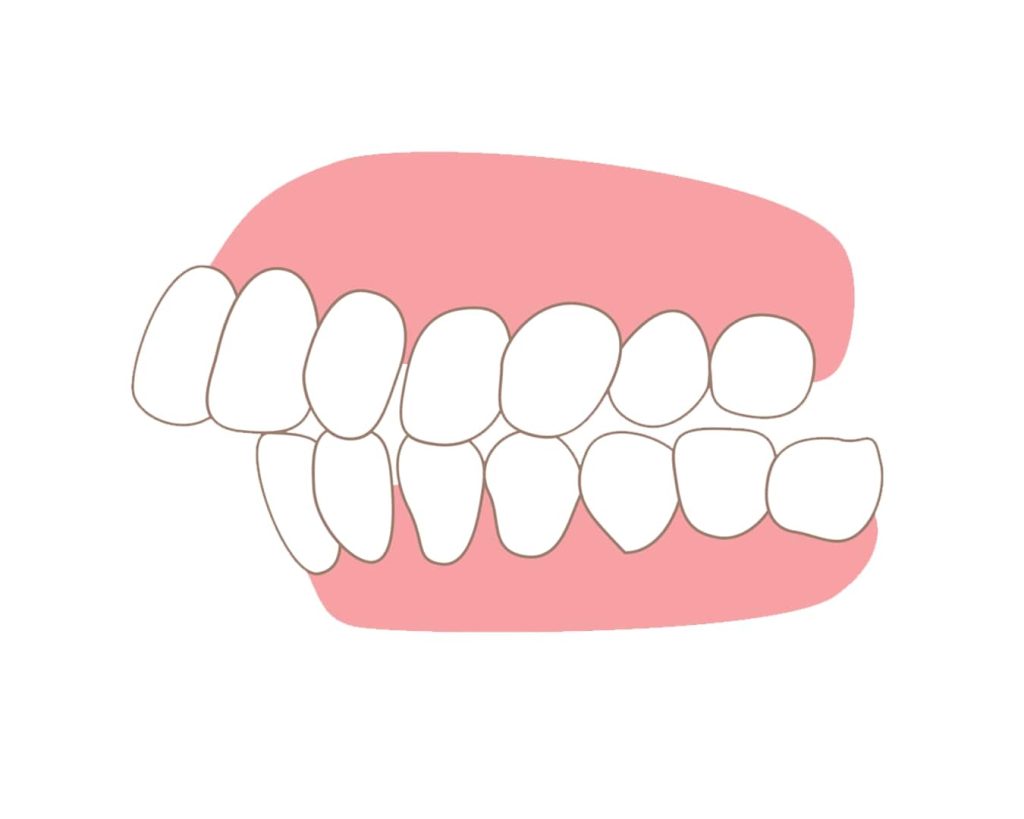 răng hô nặng