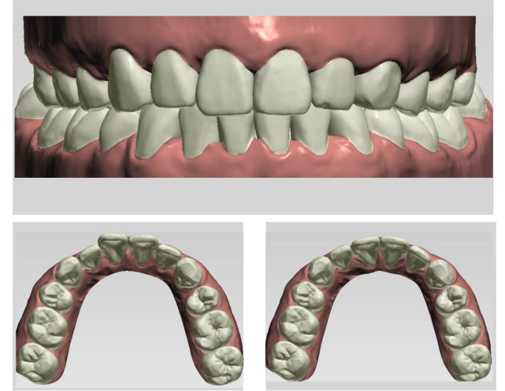 hình ảnh mô phỏng răng 3D