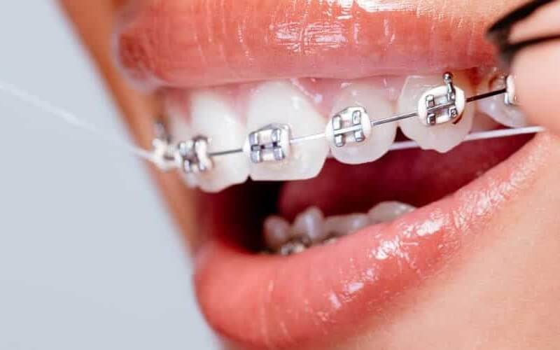 niềng răng mắc cài thường gây đau nhức