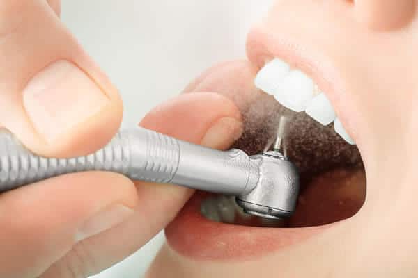Phương pháp điều trị răng vẩu - mài răng