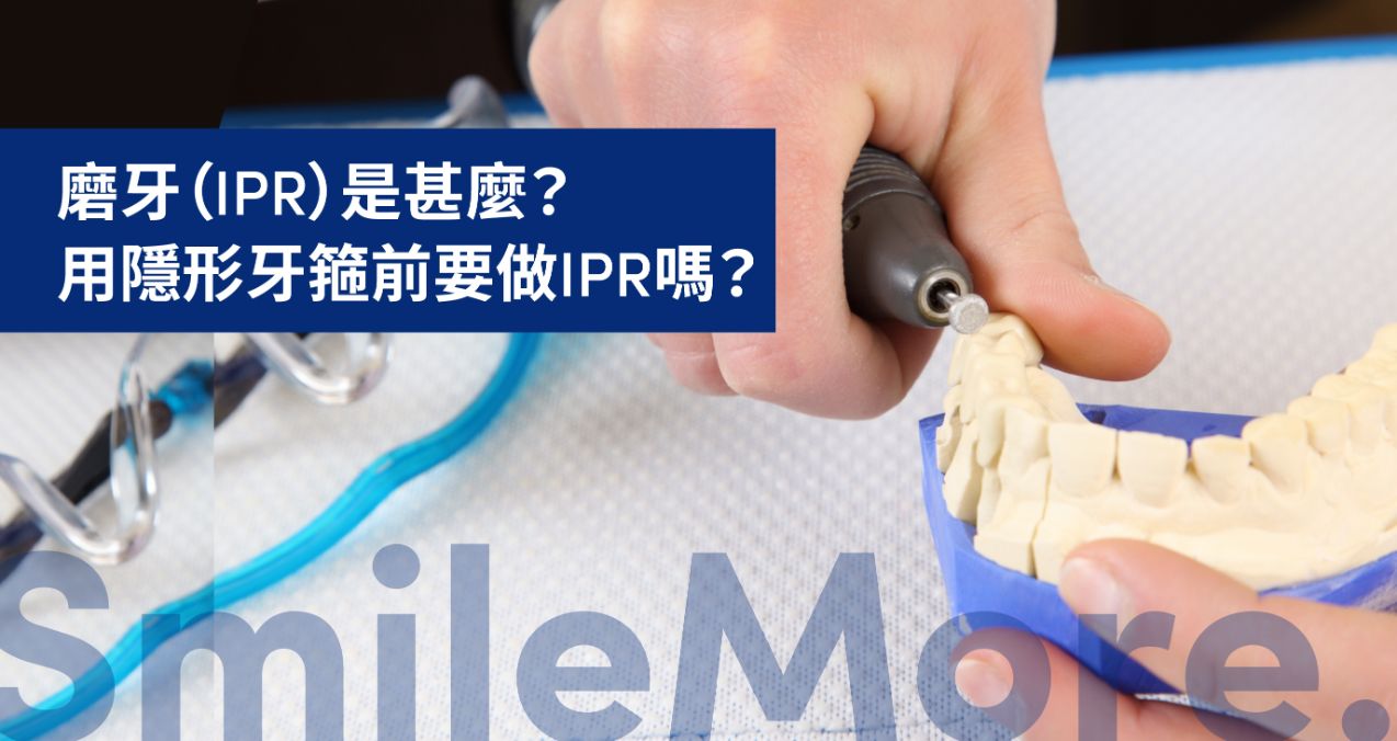 磨牙（IPR）是甚麼？用隱形牙箍前需要做IPR嗎？