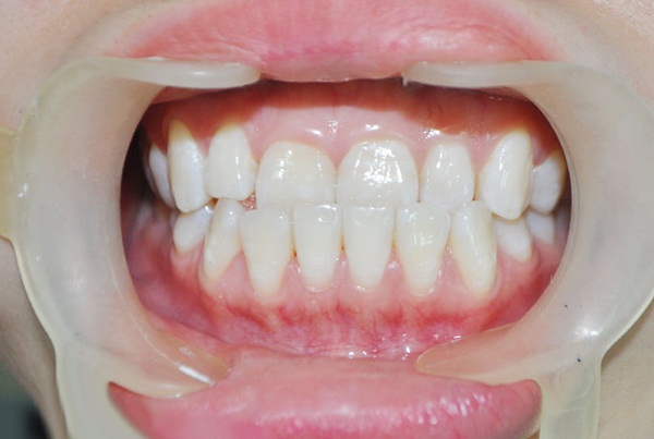 răng vẩu hàm dưới