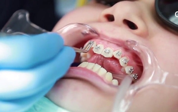 Niềng răng có đau không - giai đoạn gắn mắc cài và dây cung