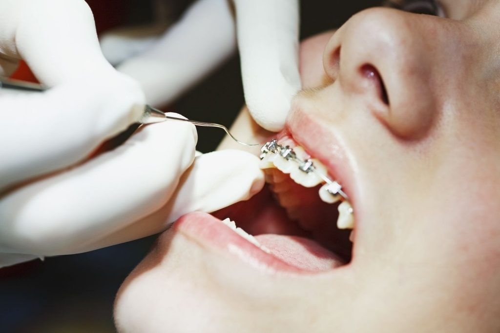 Niềng răng có đau không - giai đoạn tháo niềng răng