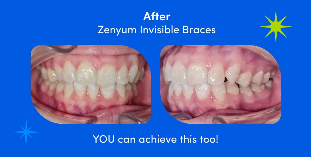 After zenyum invisibile braces results