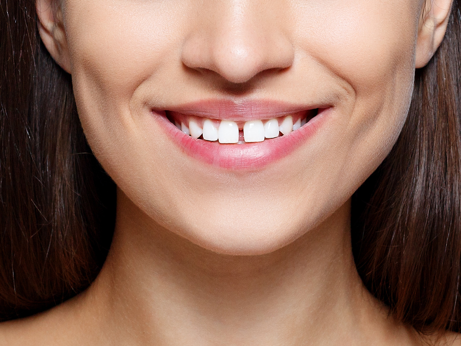 Girl smiling with gaps in between teeth