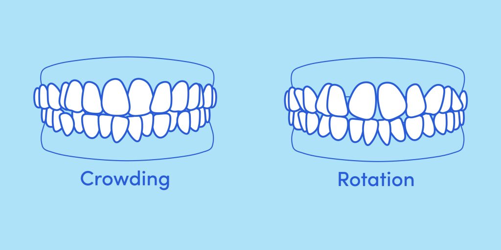 Teeth mockup of crowding of teeth and rotation bite issue