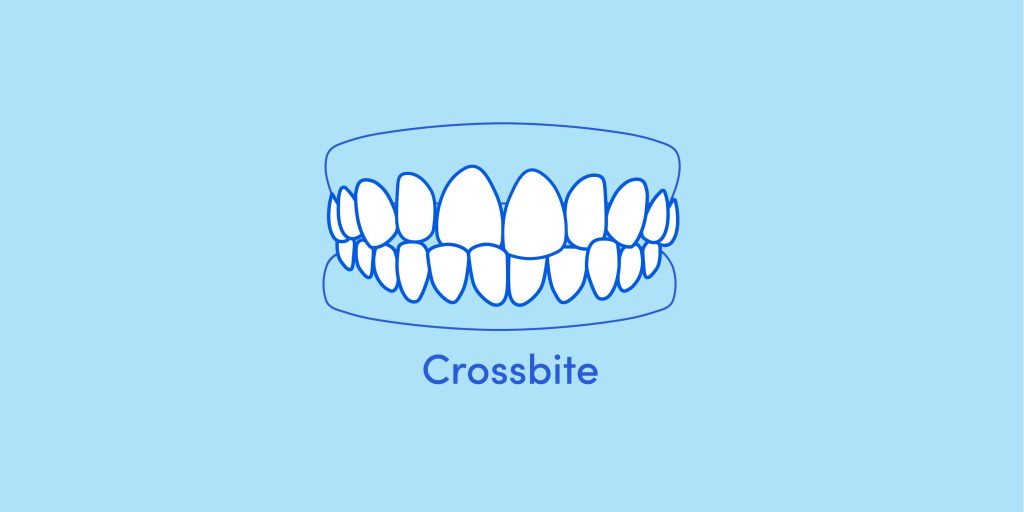 Teeth mockup of a crossbite