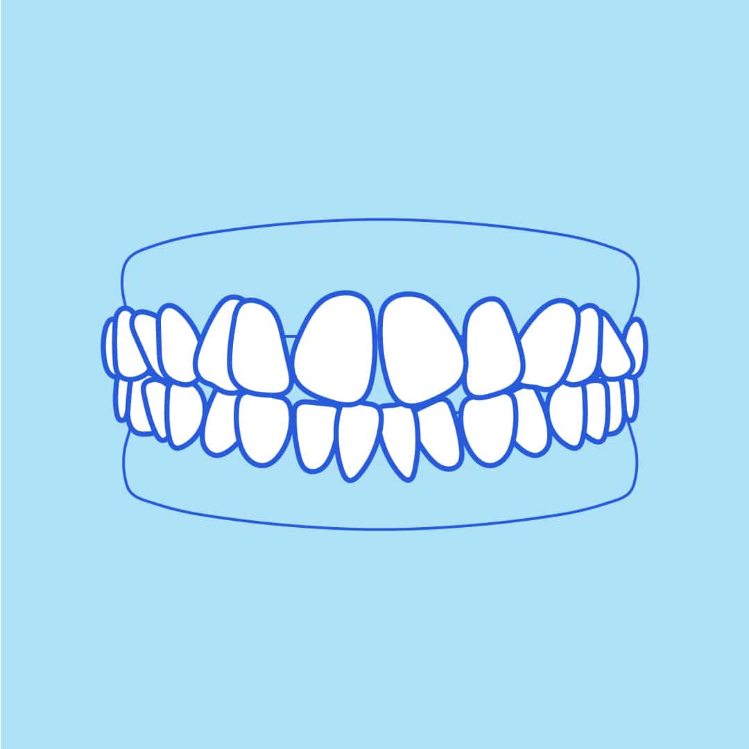 Diagram of crooked teeth