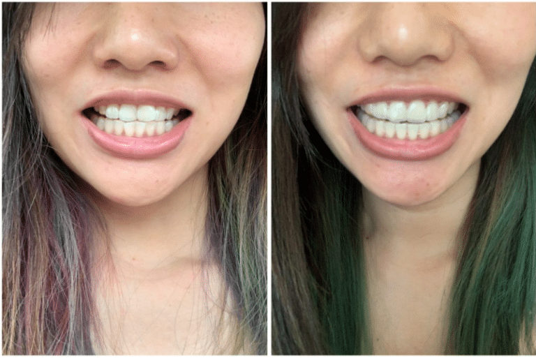 Cherie before and after Zenyum clear aligners
