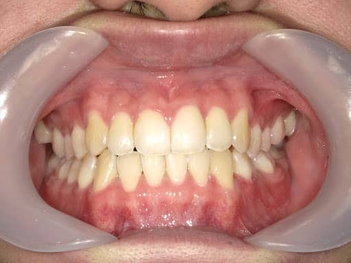 患者完成 Zenyum 微笑之旅前的牙齒非常整齊