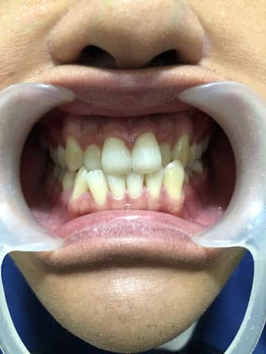 患者在箍牙前的牙齒狀況