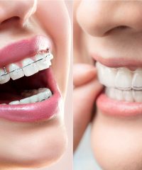 Invisible braces and metal braces comparison